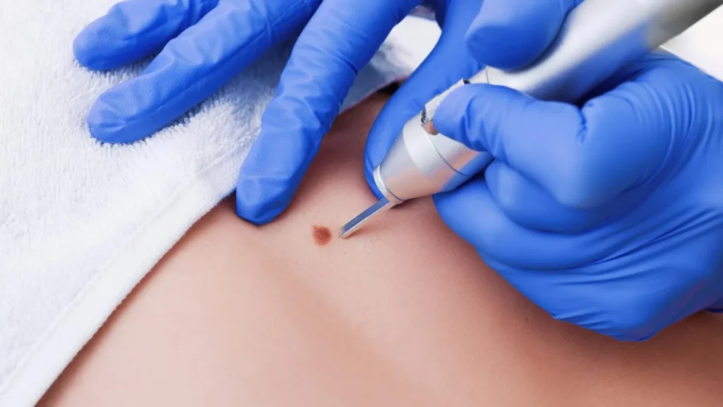 How to Remove a Lipoma Without Surgery