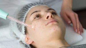 Is Hydrafacial Good for Acne?