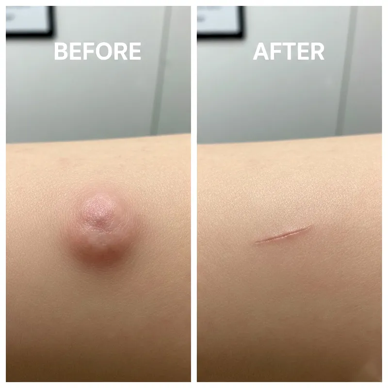 Cyst Removal Surgery
