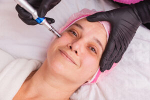 Does Microneedling Tighten Skin