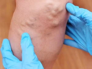 How to Remove a Lipoma Without Surgery-feature