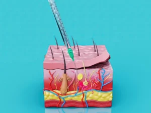 How to Remove a Lipoma Without Surgery-feature