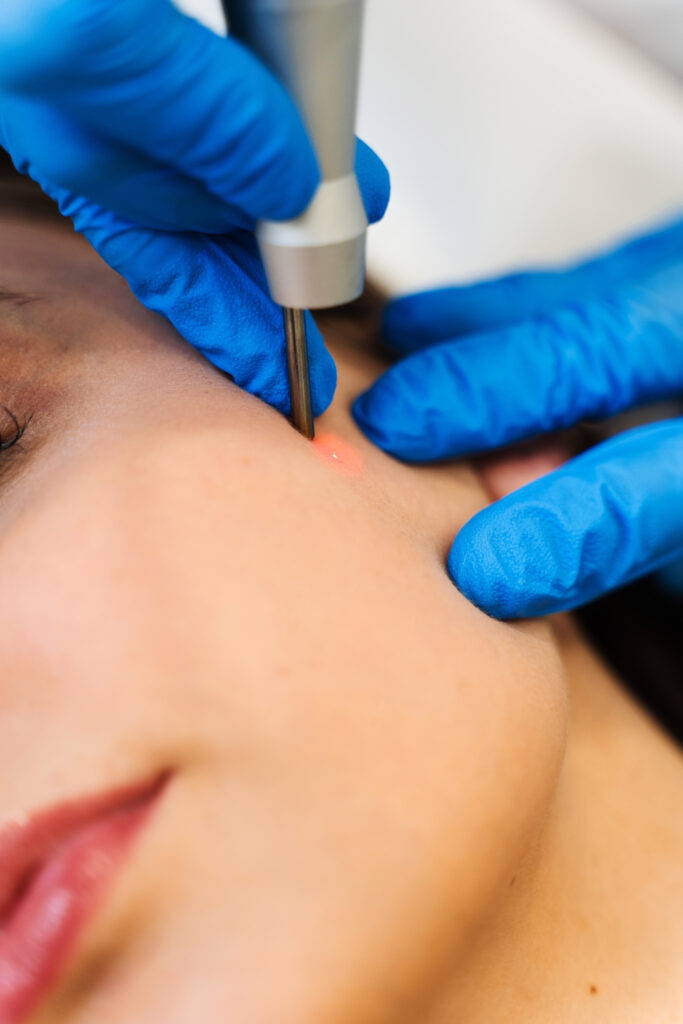 Skin tag removal keighley