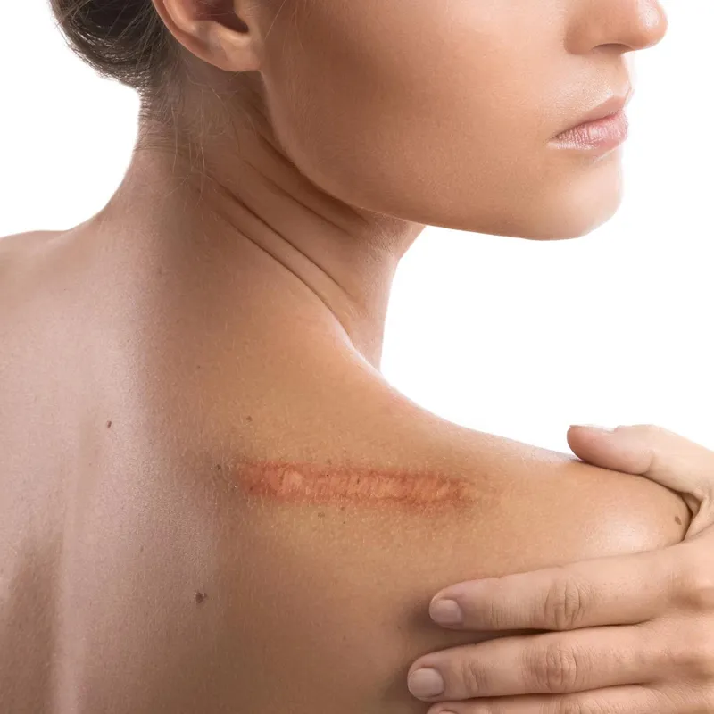 Keloid Scar Removal Keighley