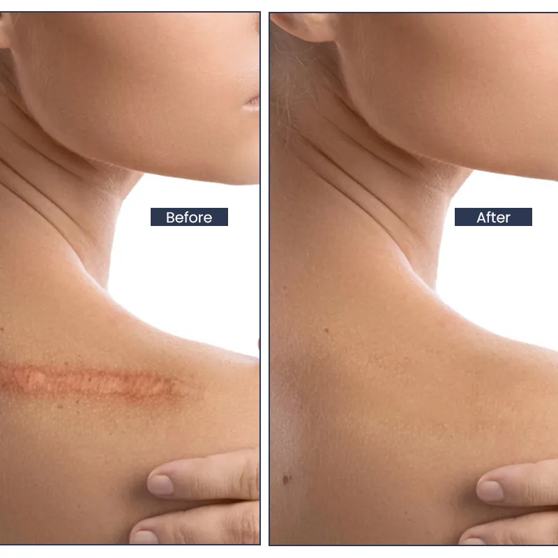 Keloid Scar Removal Keighley