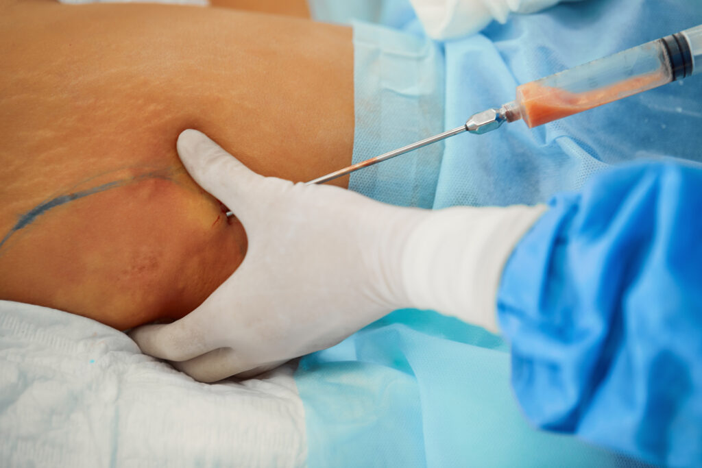 Lipoma Removal Keighley & Bradford