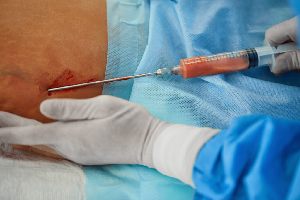 Lipoma Removal Keighley & Bradford