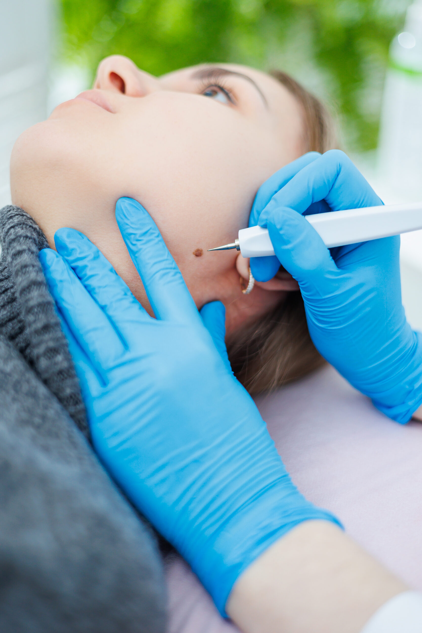 Skin tag removal keighley