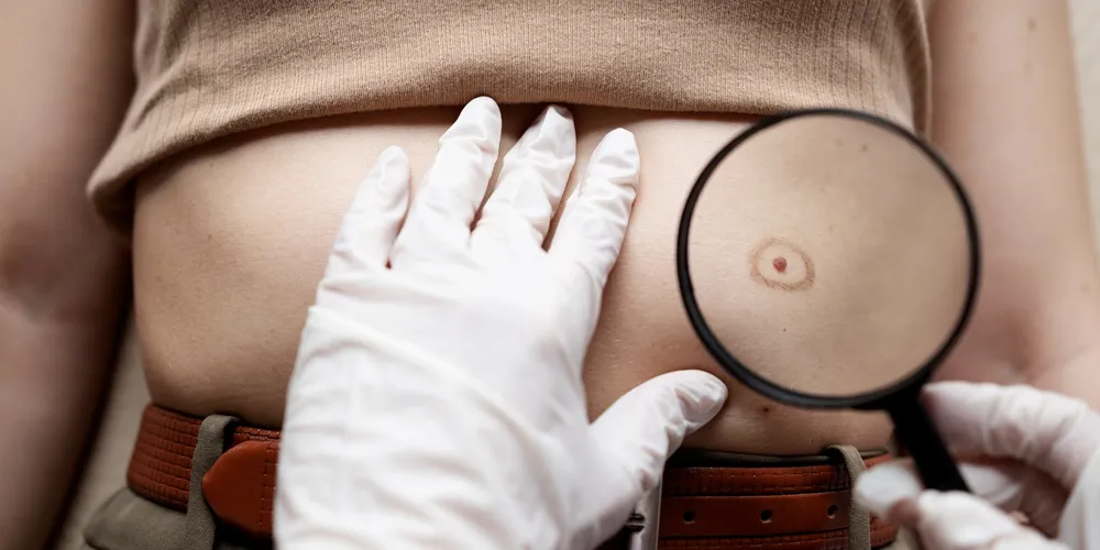 Can a Lipoma Be Removed Without Surgery?