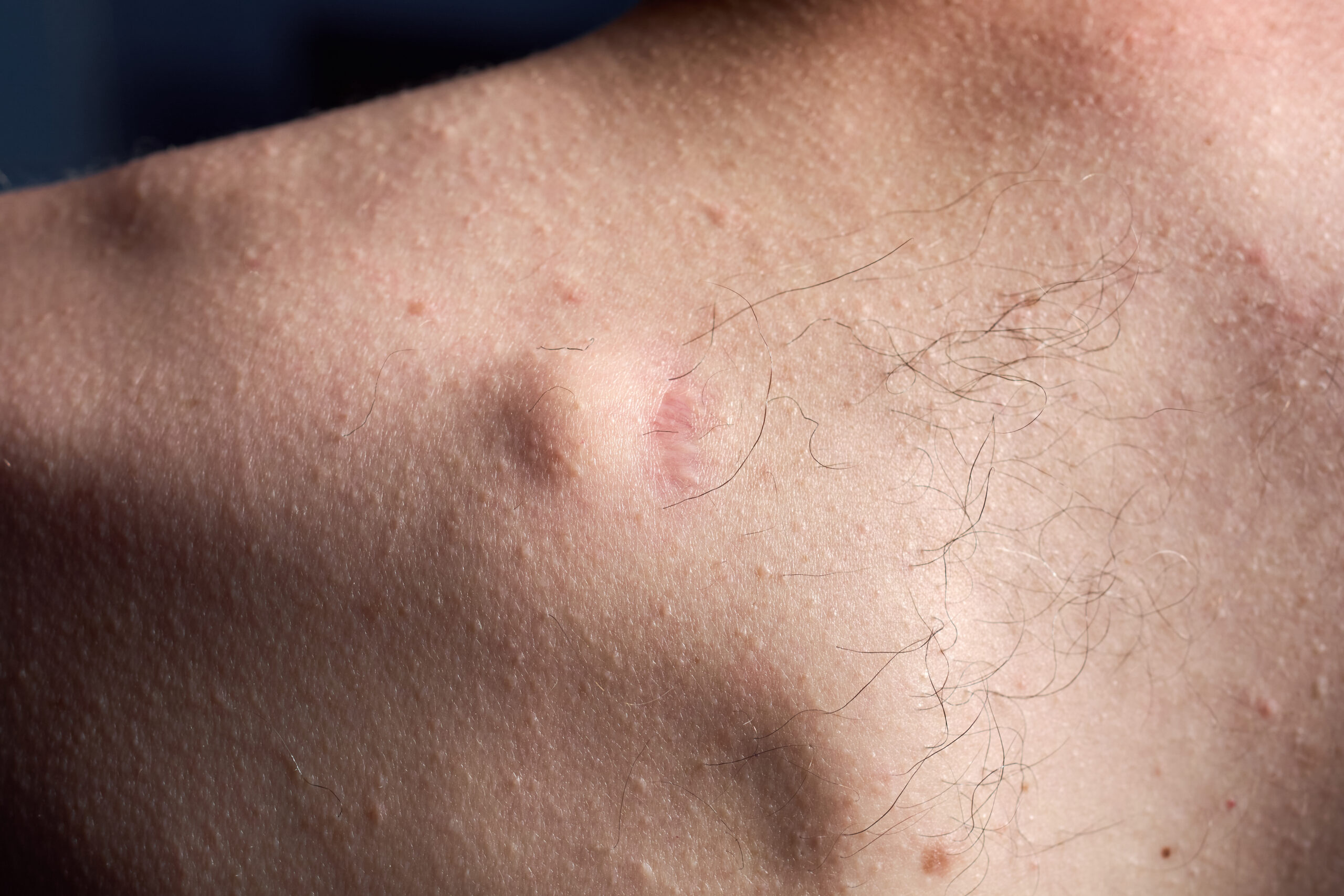 Lipoma Removal Keighley & Bradford