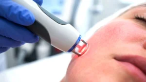 Can Laser Treatment Cure Acne?