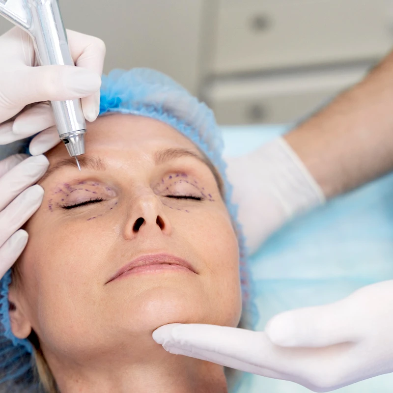 Blepharoplasty Keighley & Bradford