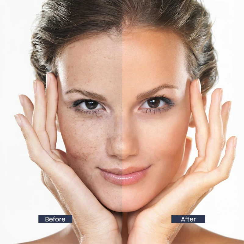 Professional Dermaplaning Keighley