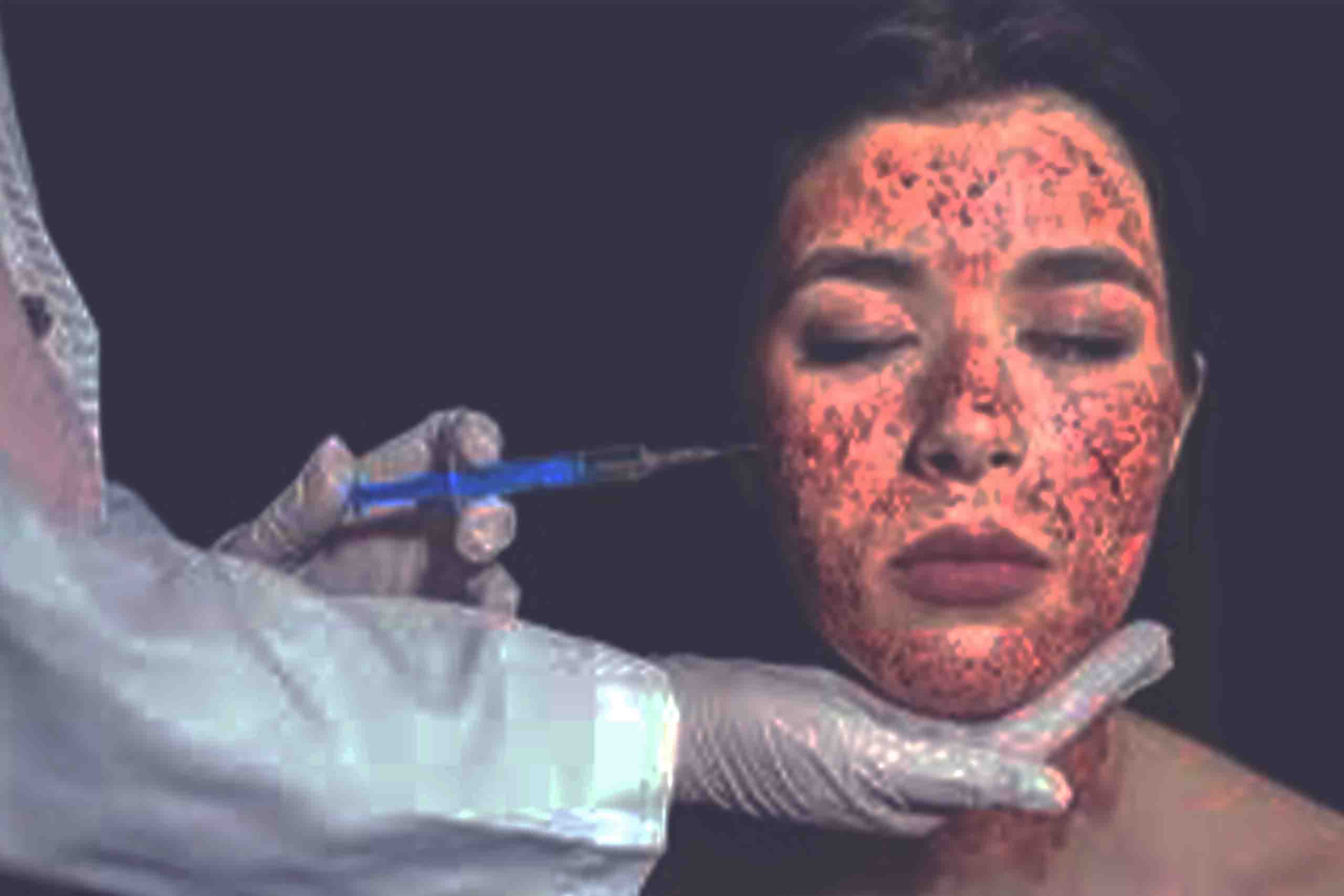 PRP Vampire Facial Keighley