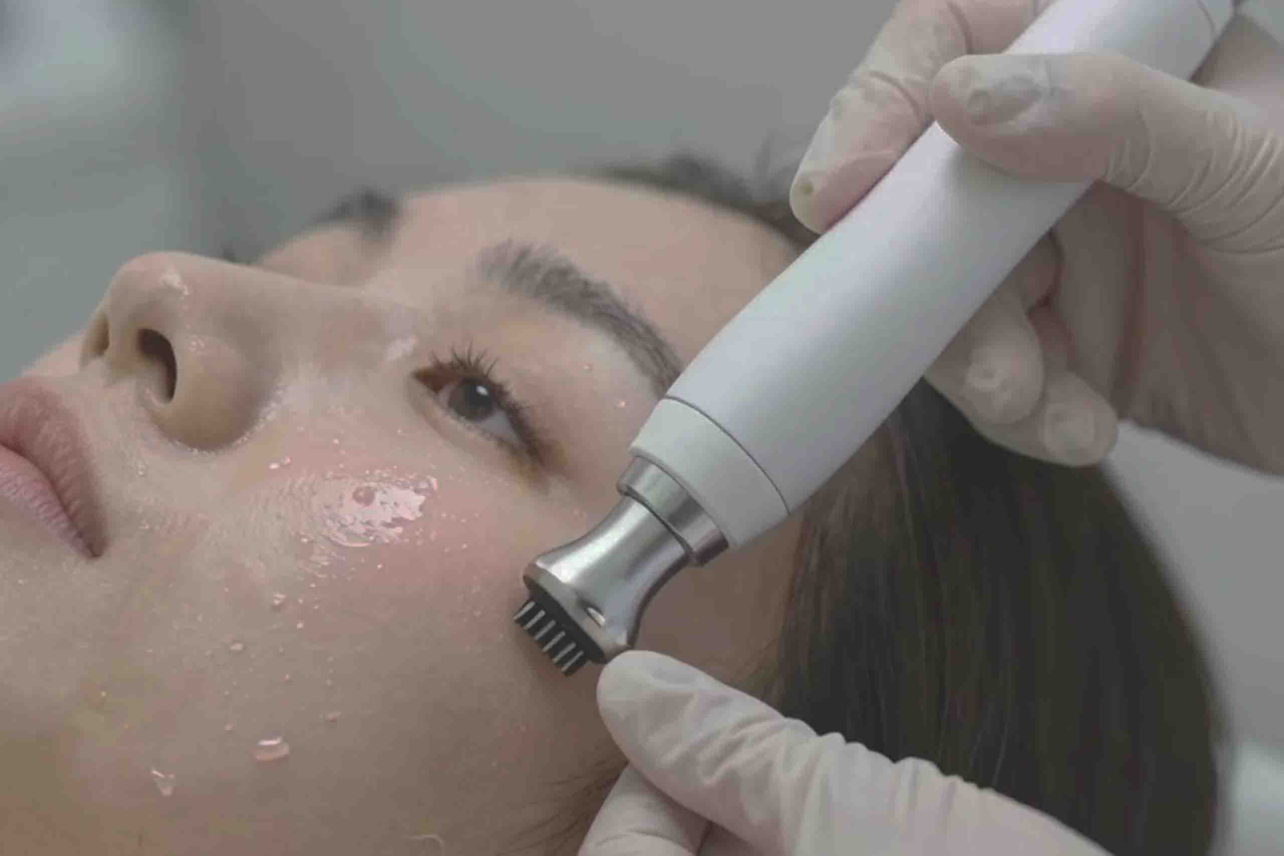 PRP Vampire Facial Keighley
