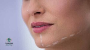 Does Jaw Filler Help With a Double Chin