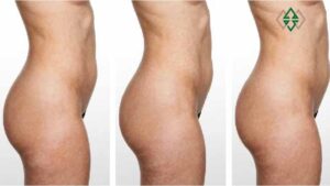 What Is Buttock Augmentation