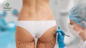 What Is Buttock Augmentation