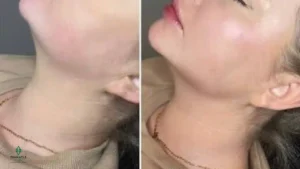 Does Jawline Filler Make Your Face Wider?