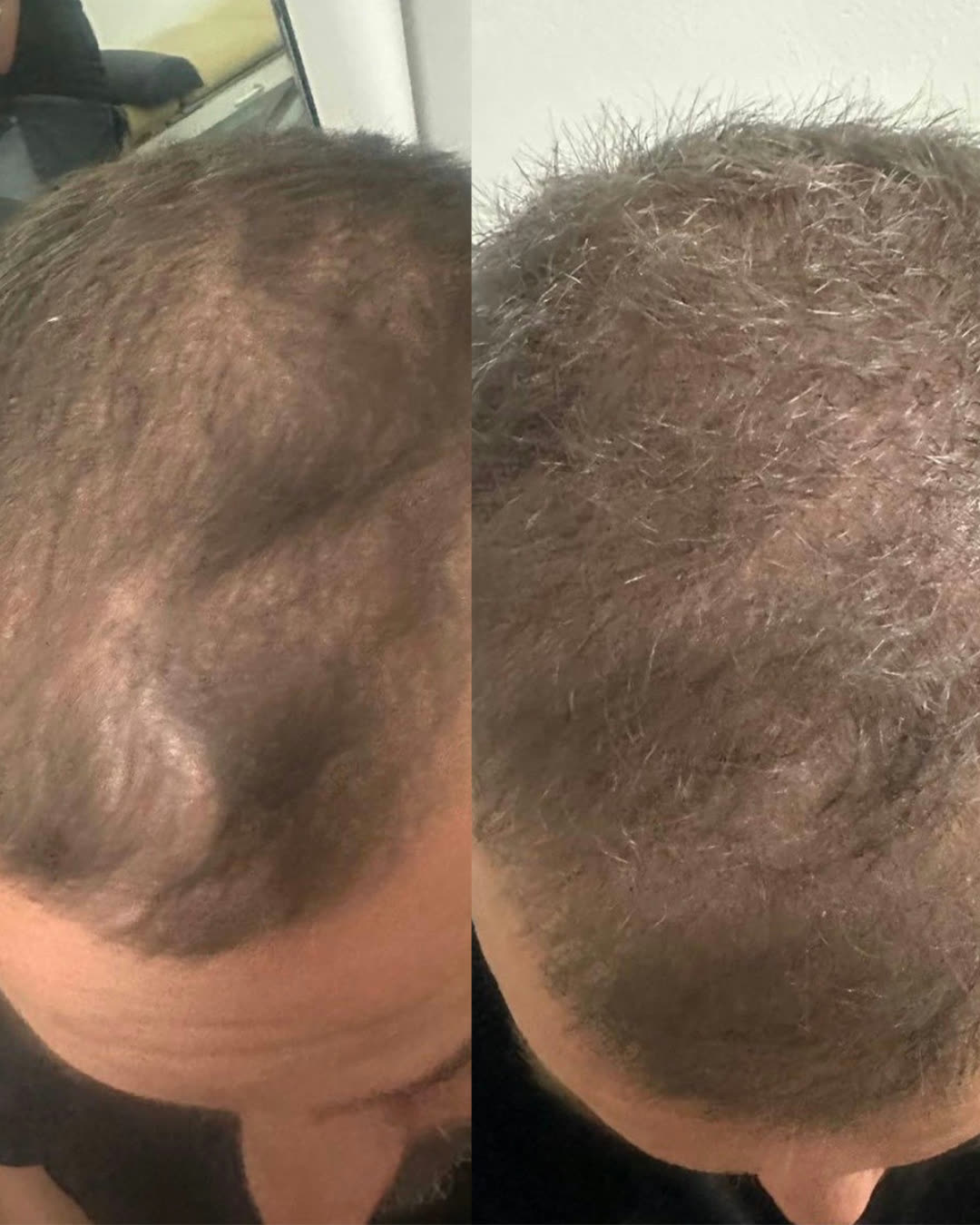PRP hair restoration before and after