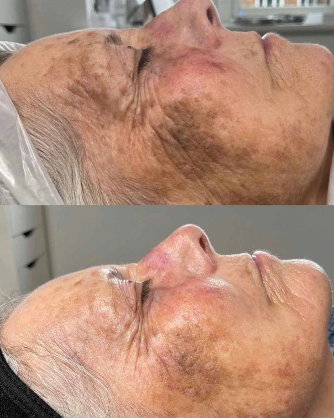 Pigmentation treatment before and after