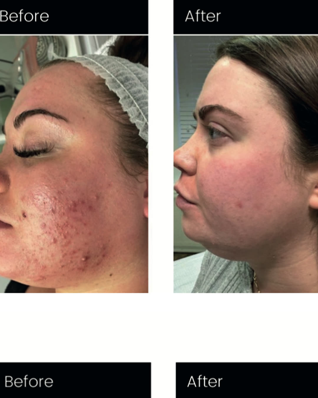 Skin treatment before and after