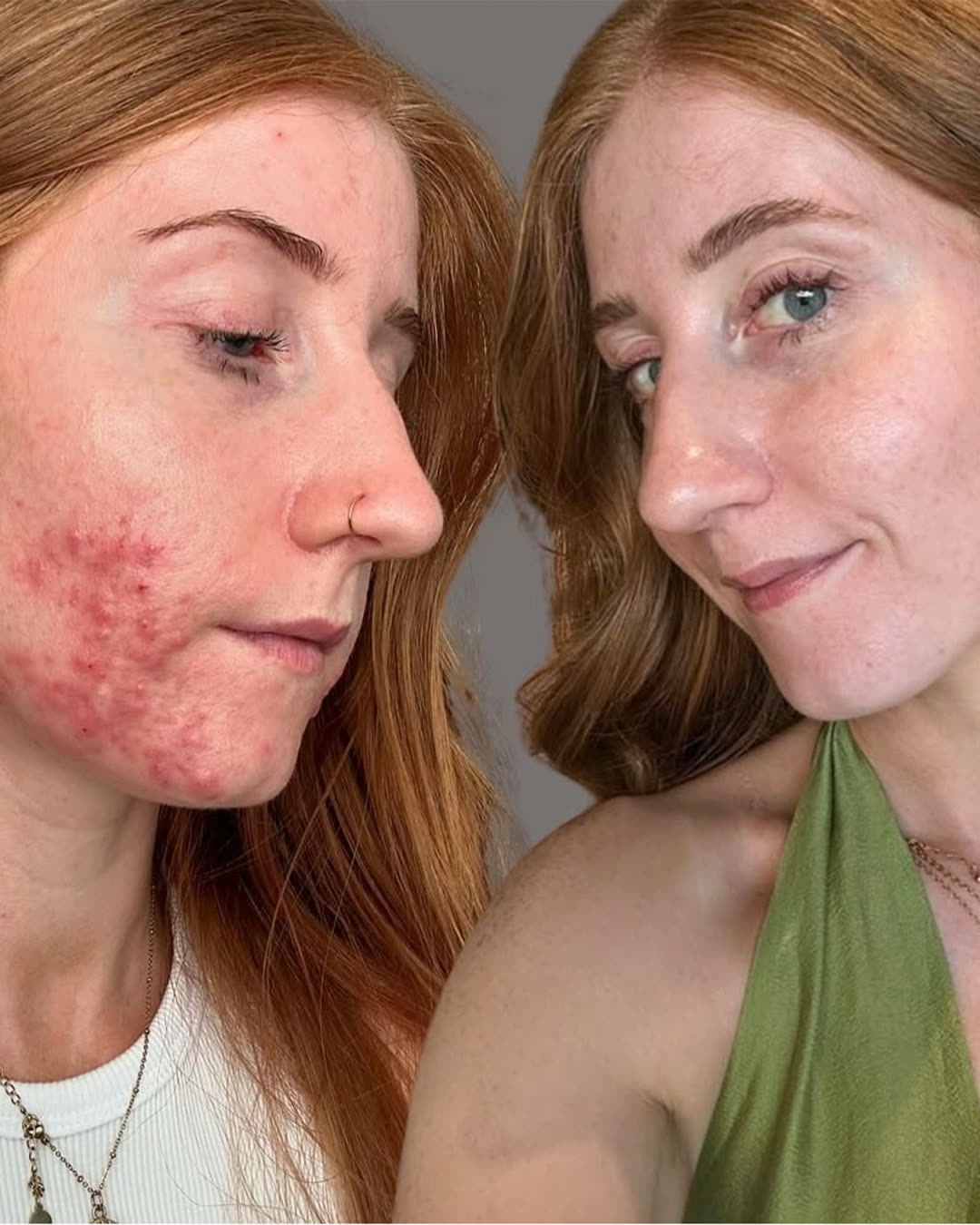 Acne treatment before and after