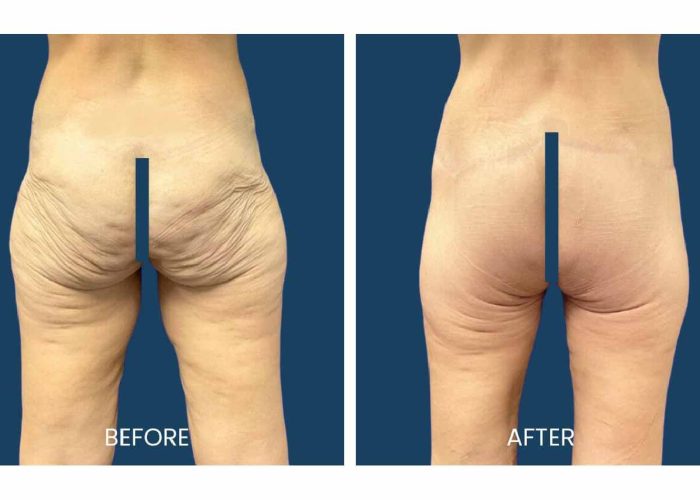 Buttock Augmentation Keighley