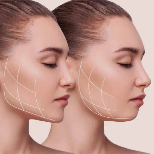 Chin Filler Keighley