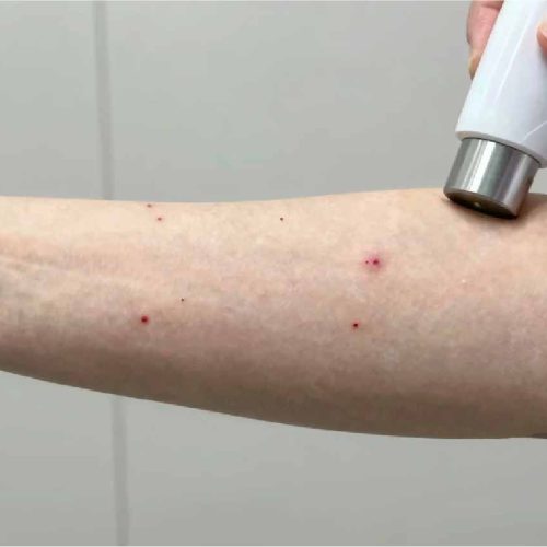 Cherry Angioma Removal Skipton