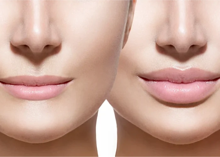 Lip Filler Skipton