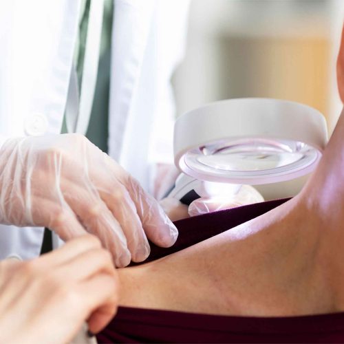 Cyst Removal Skipton
