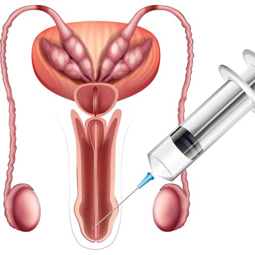 Penile Enlargement keighley