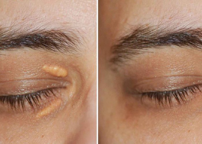 Xanthelasma Removal Skipton