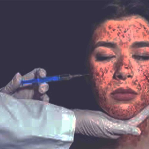 PRP Vampire Facial Keighley