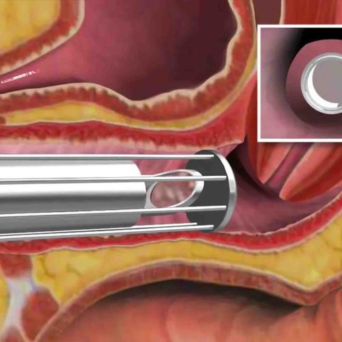 Vaginal Rejuvenation Keighley