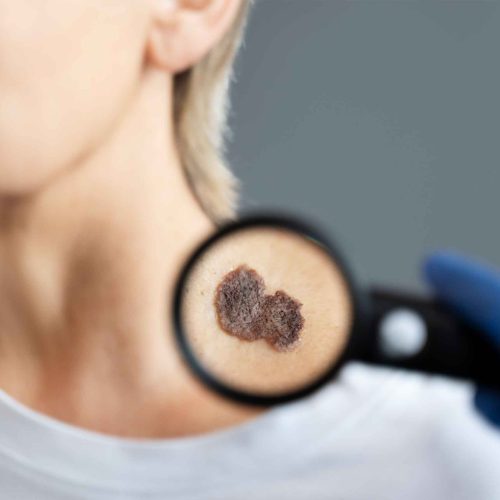 Wart Removal Skipton
