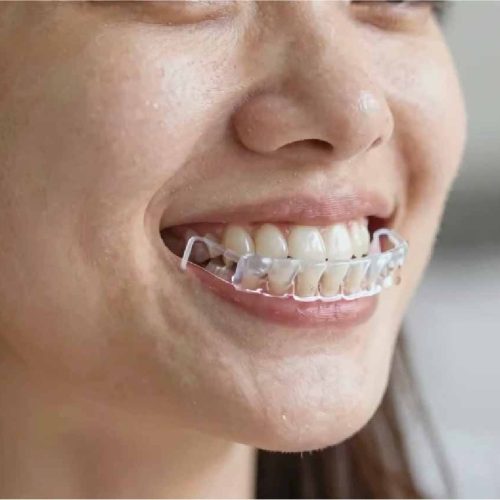 Bruxism Treatment Keighley