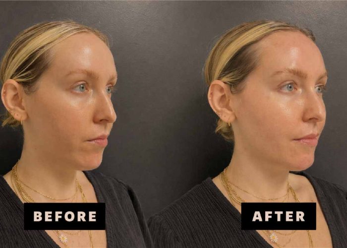 Chin Filler Keighley