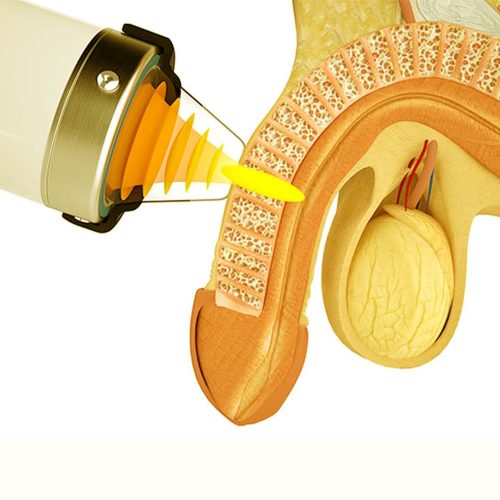 PRP for Erectile Dysfunction Keighley