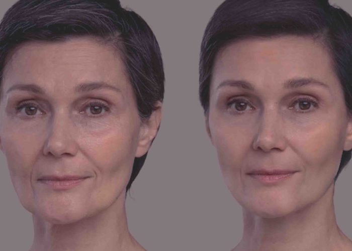 Non-Surgical Face Lift Keighley