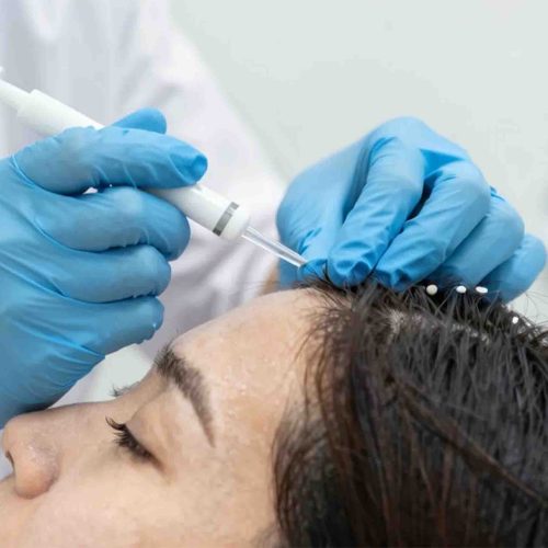 PRP Hair Restoration Keighley