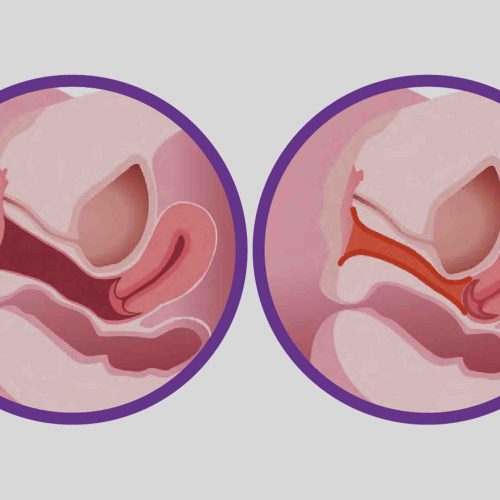 Vaginal Rejuvenation Keighley