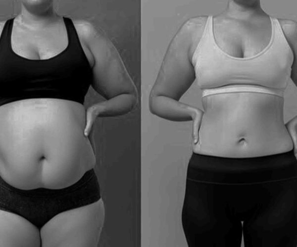 Fat Dissolving Treatment Keighley