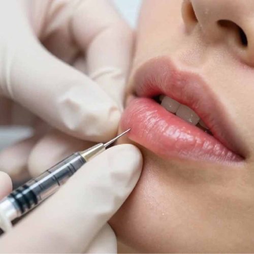 lip fillers keighley