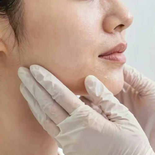 Jawline Filler Keighley