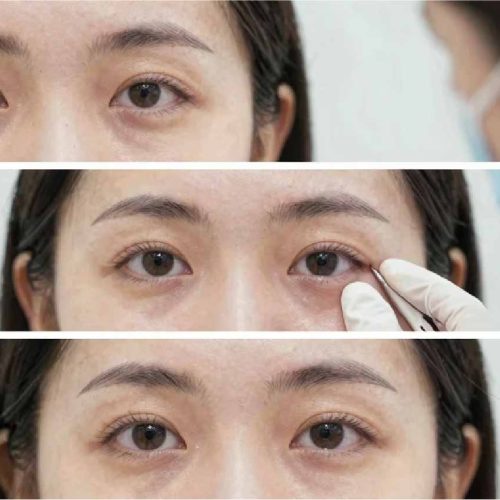 Tear Trough Filler Keighley