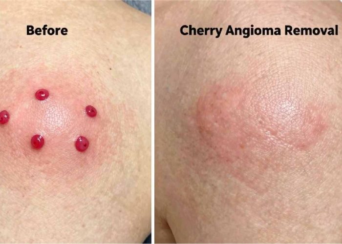 Cherry Angioma Removal Skipton (Before and after)