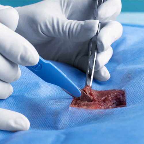 Cyst Removal Skipton