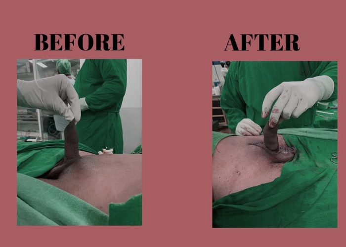 Penile Enlargement keighley before and after